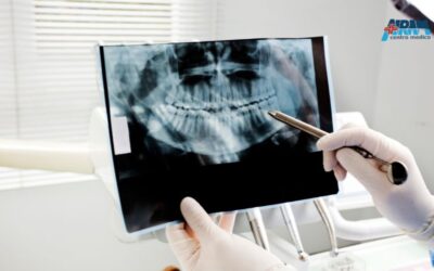 Impianti dentali: cosa sono e alternative alla dentiera