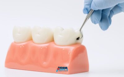Differenza tra placca e tartaro: rischi per denti e gengive