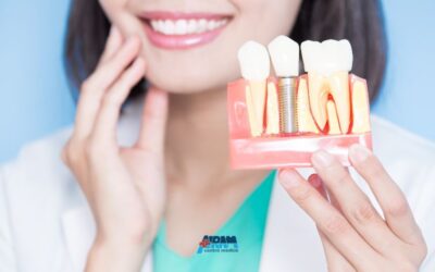 Costo impianti dentali: quanto si spende e come funzionano i finanziamenti